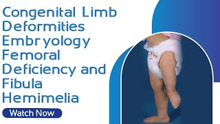 Congenital Limb Deformities  Embryology  Femoral Deficiency and Fibula Hemimelia [upl. by Willem369]