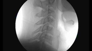 Cervical Spine Video Fluoroscopy  Chiropractic Care [upl. by Ira]