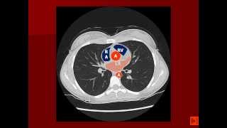 Normal Chest CT with labels [upl. by Gobert]