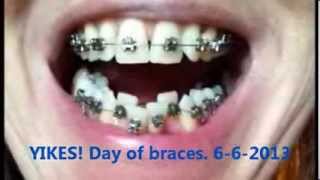 Adult Braces  My Journey  0 to 5 months progress [upl. by Christmann]