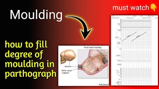 Moulding  Fetal head moulding  labour process easy explanation in hindi  Nursing guidance [upl. by Golda]