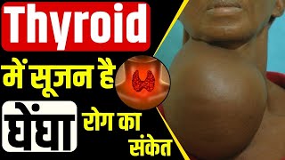 Goiter Causes Diagnosis Symptoms and Treatment  क्या है घेंघा रोग  Dr Kanchan Singh। [upl. by Arriat]