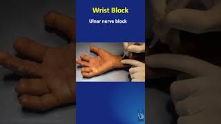 Shorts 25 Regional anaesthesia blocks Practical wrist block  in a minute [upl. by Chastity]