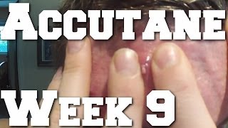 Lifting HEAVY Side Effects amp Cysts on Accutane Week 9 [upl. by Miof Mela]