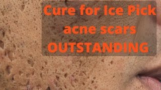 How to treat ice pick acne scars [upl. by Ailina]