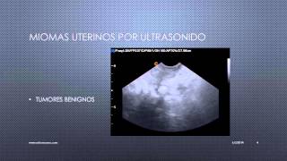 MIOMAS UTERINOS VISUALIZADOS POR ULTRASONIDO [upl. by Balliett]