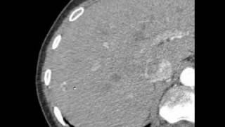 CT interpretation  hemangioma liver [upl. by Nevaj]