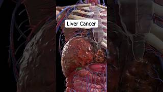 12 Liver cancer symptoms liverhealth health healthtips shorts [upl. by Anivram]