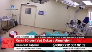 Yağ Alma Liposuction  Karın Bölgesi [upl. by Pacificia]