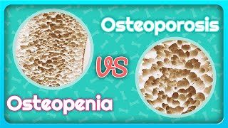 Osteoporosis vs Osteopenia Whats the Difference [upl. by Githens667]