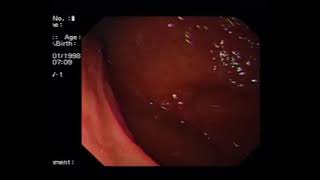 portal hypertensive gastropathy [upl. by Notned]