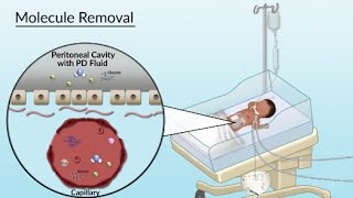 Peritoneal Dialysis by S Su A Olszewski  OPENPediatrics [upl. by Htebzil878]