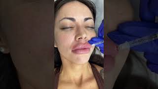 Lips Filler Treatment by our Cathy  Ageless MD [upl. by Sperling]