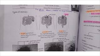 stomasileostomy vs colostomysurger final year lower gi lecture [upl. by Suryt]