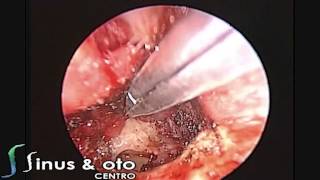 Glomus Tympanicum Endoscopic Transcanal Management [upl. by Joycelin71]