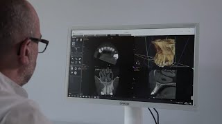 CS 9600 CBCT System – CS MAR with unique live comparison tool [upl. by Natehc907]