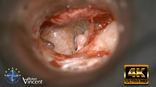 Traumatic Incus Dislocation  Total Ossicular Reconstruction  Malleus Relocation amp Silastic Banding [upl. by Hsina145]