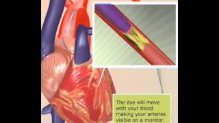 Angiogram [upl. by Tips]