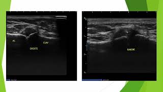 Articulation acromioclaviculaire en échographie [upl. by Jet]