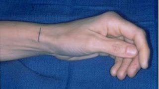 Know the Difference Dupuytrens Contracture and Carpal Tunnel Syndrome [upl. by Natloz863]