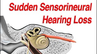 Sudden Sensorineural Hearing Loss Diagnosis Causes and Treatment [upl. by Mimi]