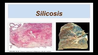 Silicosis [upl. by Ettena]