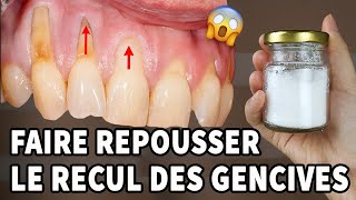 Incroyable Il S’agit D’un Remède À La Maison Pour La Récession Gingivale [upl. by Farrel966]