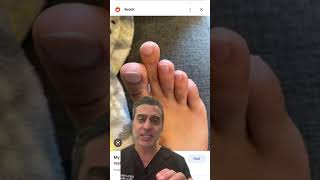 What Is Mortons Toe a Long Second Toe [upl. by Oman]