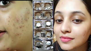 most effective acne face mask  Treatment of acne with DISPRIN  How to use DISPRIN as skincare [upl. by Atrebor]