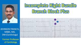 Incomplete Right Bundle Branch Block Plus [upl. by Draneb804]