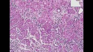 Histopathology Esophagus Herpes esophagitis [upl. by Murtagh673]