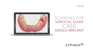 3Shape TRIOS  Scanning for surgical guide  Single implant case [upl. by Dorej9]