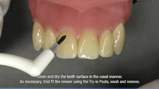 Panavia V5 how to work flow laminate veneer cementation [upl. by Ffej]