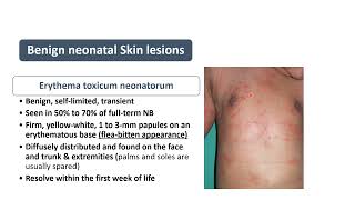 Erythema Toxicum Neonatorum  Spot Diagnosis 25  Pediatrics [upl. by Oicor]