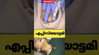 പ്രസവസമയത്ത് episiotomy ചെയ്യുന്നത്pregnancy education malayalam [upl. by Gayleen]