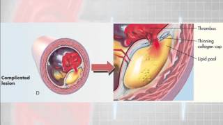 12 Lead Interpretation Part 61 Pathophysiolgoy of Myocardial Infarctions [upl. by Wallford890]