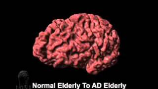 Cortical Atrophy Associated with Alzheimers Disease [upl. by Ahseinar]