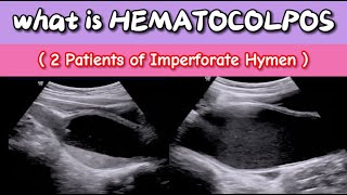 What is Hematocolpos Ultrasound  Imperforate Hymen  Blood in Vagina [upl. by Berg187]