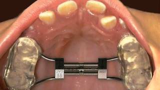 Hızlı üst çene genişletmesi Rapid Palatal Expansion [upl. by Dorr550]