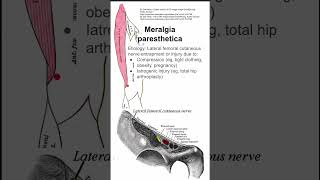 Meralgia paresthetica [upl. by Tatman307]