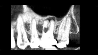 Lifeprolonging treatment for large perforations at the root canal orifice [upl. by Ayerdna]