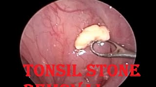 Tonsil Stone  Infected Cheesy Material Removal from Tonsillar Crypt [upl. by Catton620]