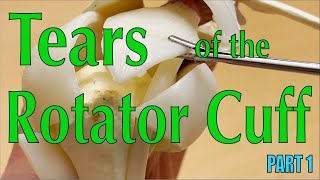 Tears of the Rotator Cuff Part 1 [upl. by Sivrahc]