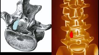 Behandlung der Spinalkanalstenose [upl. by Breger]