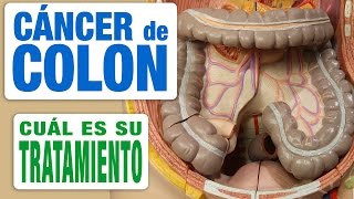 Cáncer de Colon  Tratamiento [upl. by Koss]