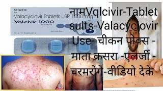 Valcivir 1000 mg Tablets Valacyclovir tablet चिकन पोक्स एलर्जी valacyclovir use Dosage Herpival [upl. by Llenrep527]