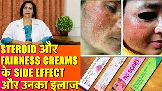 Steroid और Fairness Creams के Side Effects और उनका इलाज [upl. by Ahtamas796]