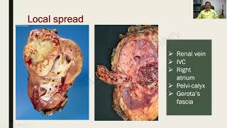 Renal Cell Carcinoma and Wilms Tumor  Renal Pathology  RATS in Pathology [upl. by Rasla875]