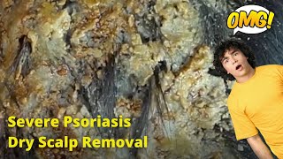 Removal of SEVERE Psoriasis Seborrheic Dermatitis Dry Scalp amsr [upl. by Corrina]