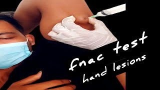 FNAC in Diagnosing Lesions Of Hand।। [upl. by Aneehsak]